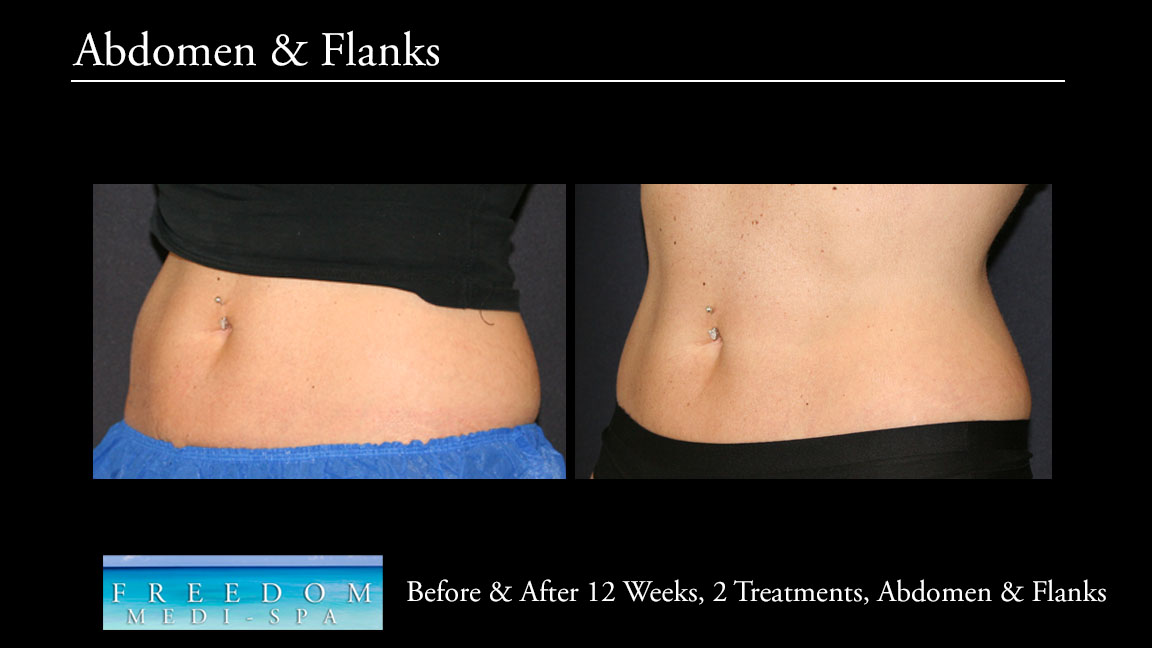 SculpSure Abs Flanks Oct 2017 4.jpg