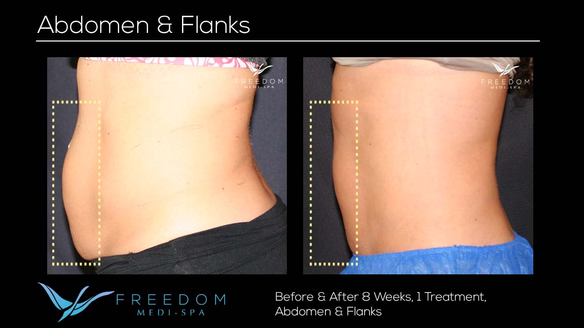 Abdomen & Flank Body Contouring, San Diego, CA