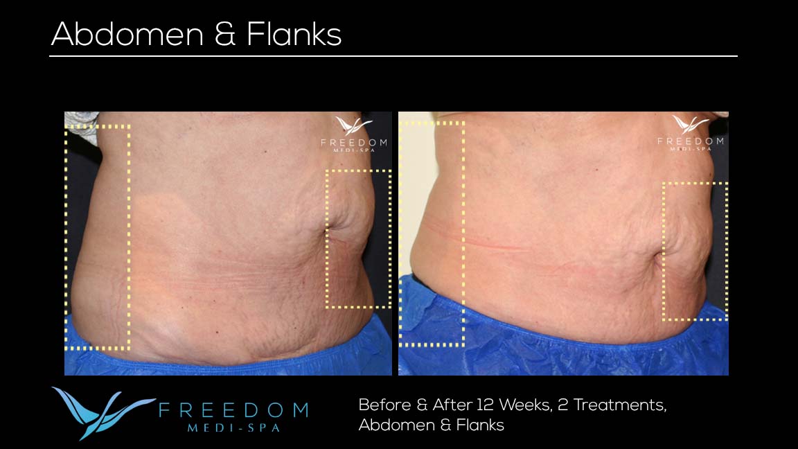 Flanks - Body Contouring - Laser And Facial Med Spa