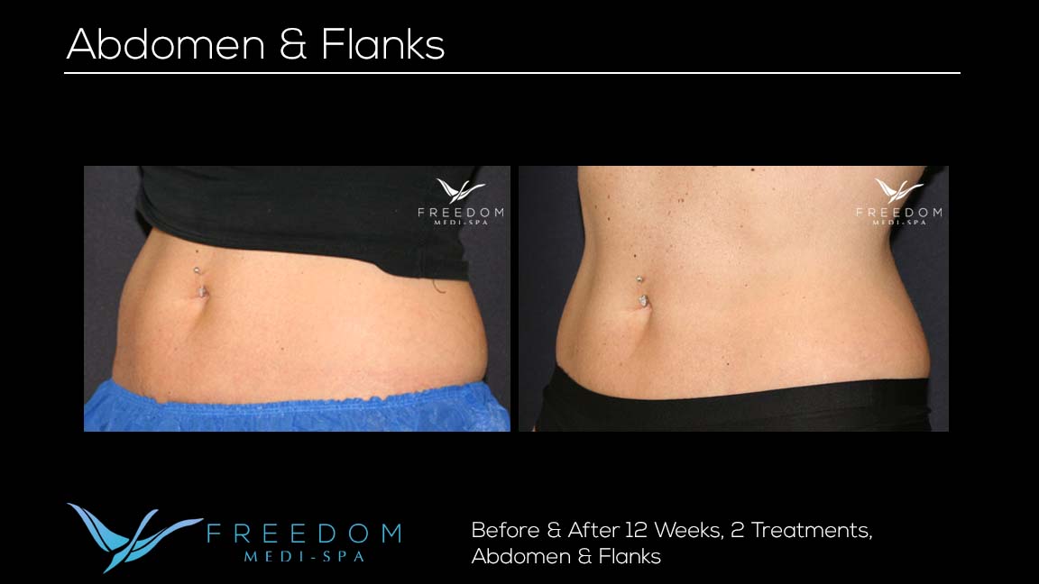 SculpSure Abs Flanks Oct 2017 4 re-branded.jpg