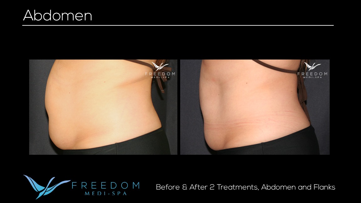 Susy's SculpSure journey before and after pics 1.jpg