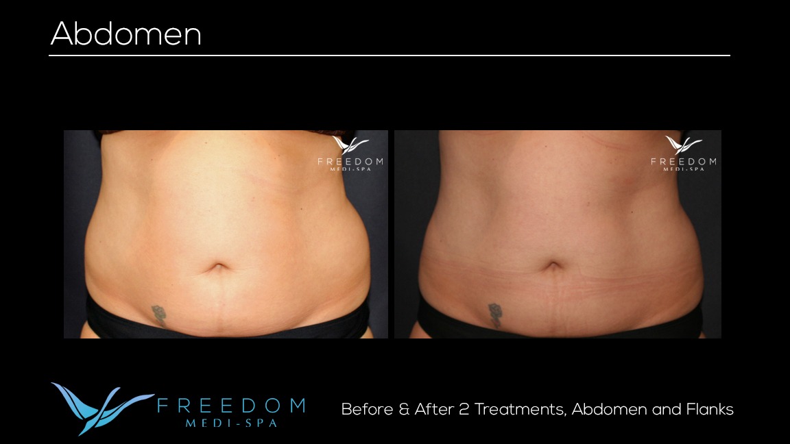 Susy's SculpSure journey before and after pics 2 .jpg