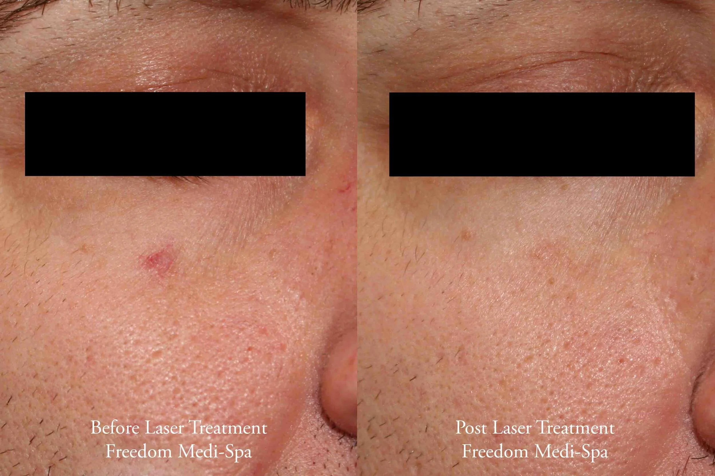 לסייע מרוכבים להסית capillary laser treatment הגבלה להשתמש סגולה