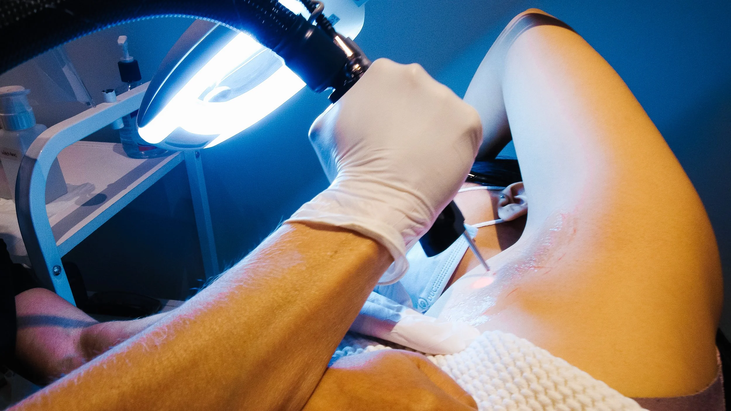 Can you do laser in the summer?