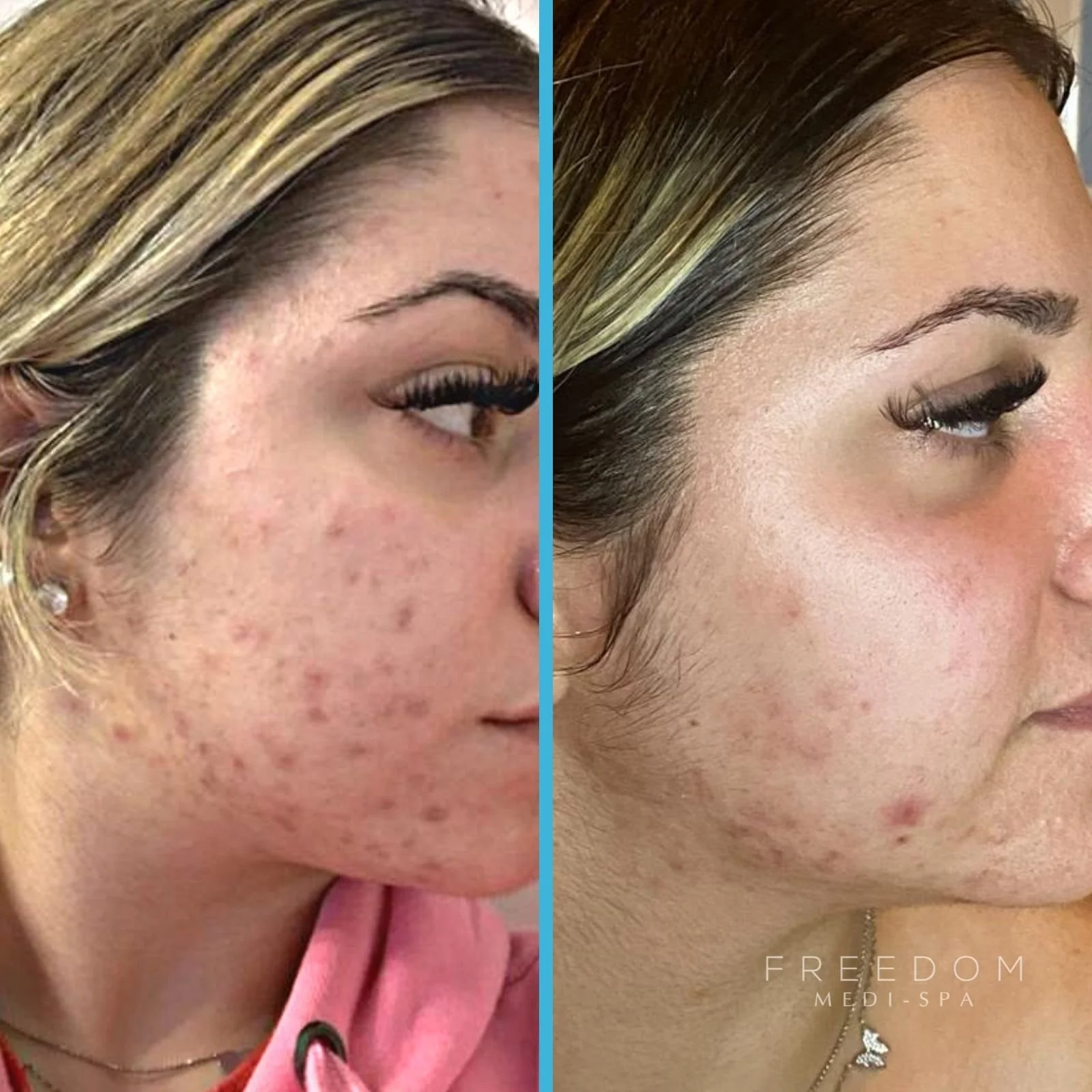 Teens and Acne — Freedom MediSpa