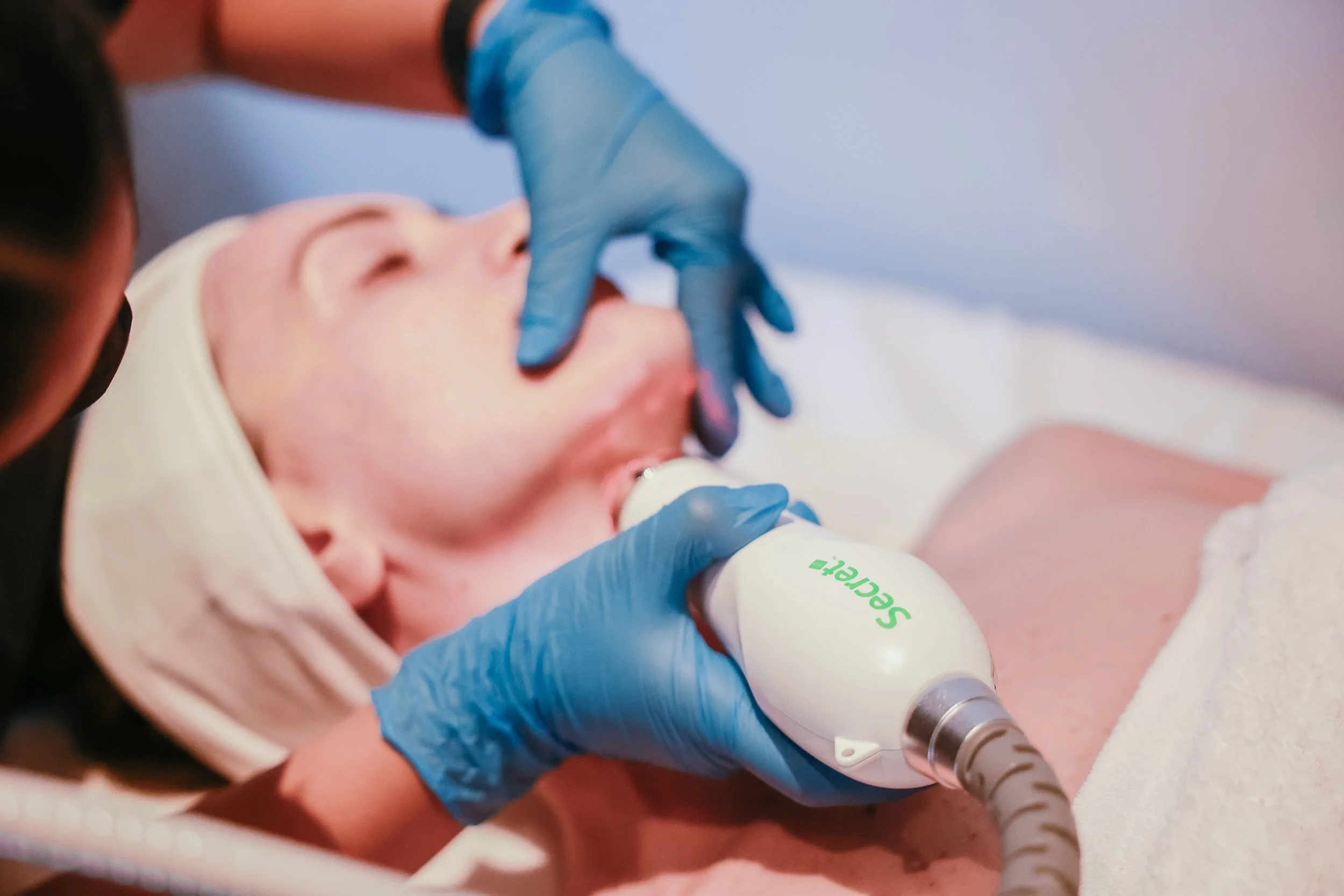 MicroNeedling With Radio Frequency Skin Treatment, Vaughan