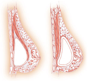 Left: submuscular. Right: subglandular.