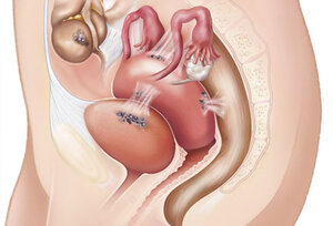 endometriosis1.jpg