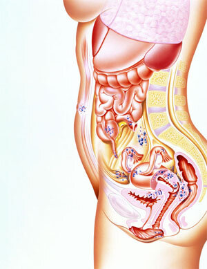 endometriosis2.jpg