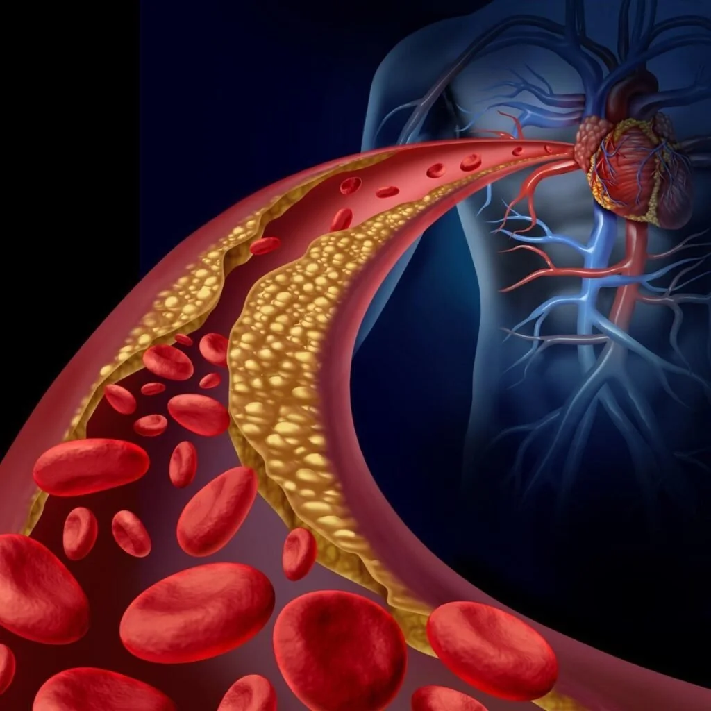 Clogged Arteries 101 and How to Prevent Them