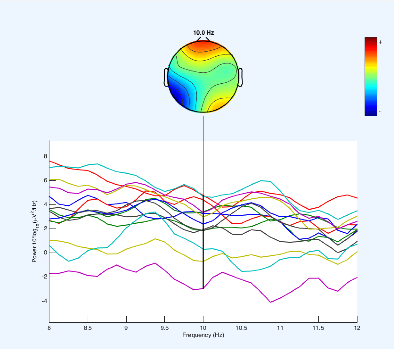 Before Patient EEG Example .png