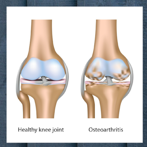 Dr. Pedro Loredo from the Loredo Hand Care Institute will explain to you how Stem Cell Therapy can help your painful joints and help your joint injuries. Please call 972-939-974 or visit our website www.loredohands.com