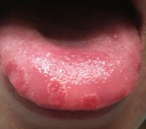 soretongue.jpg