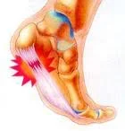 plantarfasciitis.jpg