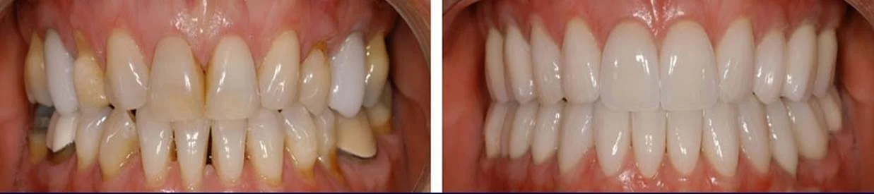 before and after cerec.jpg