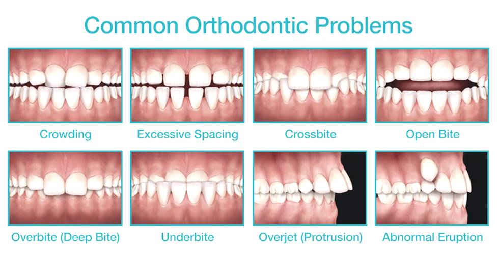 INVISIBLE BRACES — LAKEBRINK-MITTS DENTAL :: Liberty MO Dentist