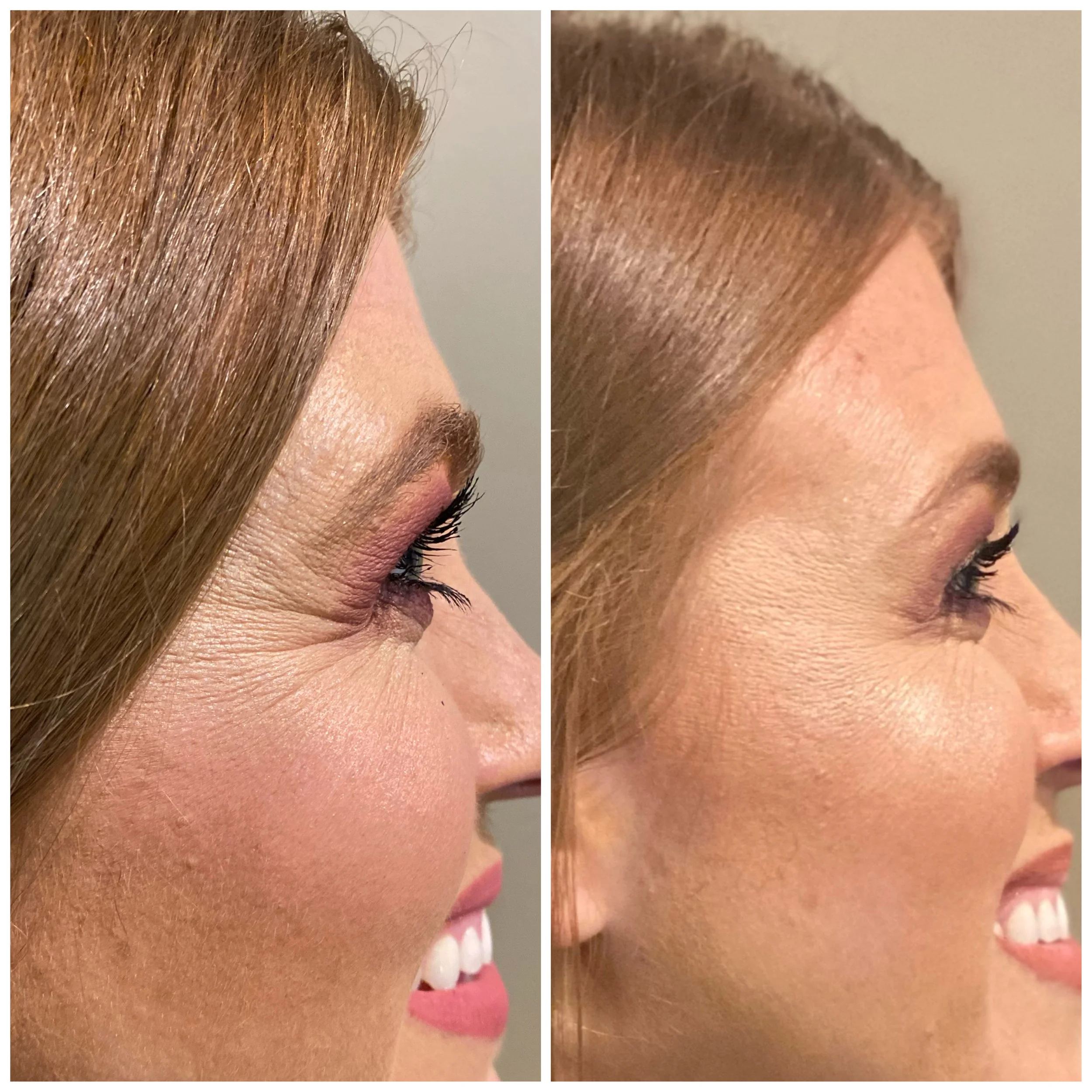 BOTOX | SMILE LINES (CROWS FEET) BEFORE + AFTER