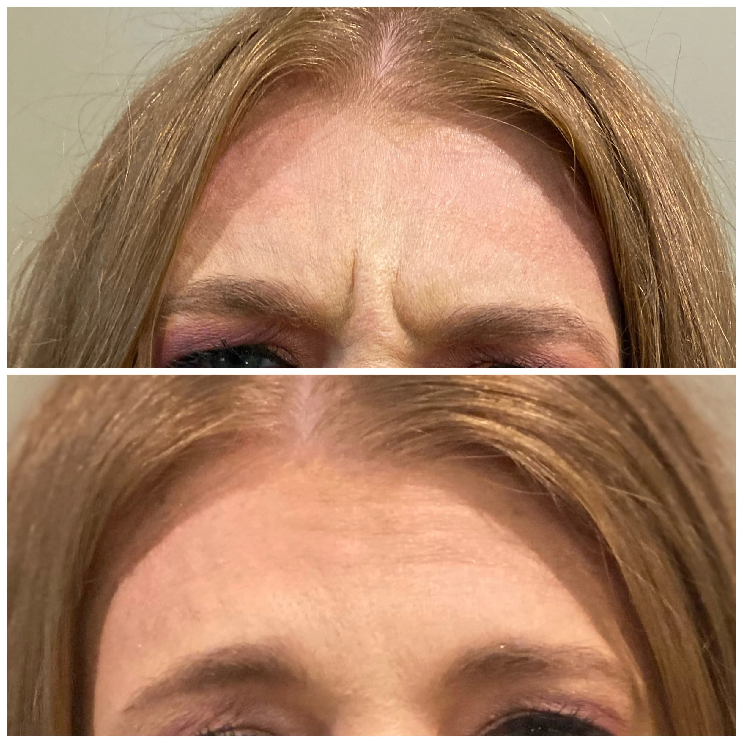 BOTOX | FROWNING ("ELEVENS") BEFORE + AFTER