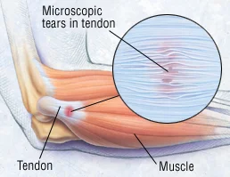 tendonitis.jpg
