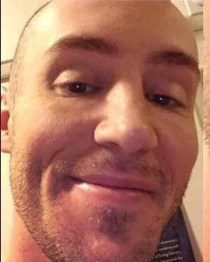 Dr. Reser in 2016 after practicing facial muscle compression.