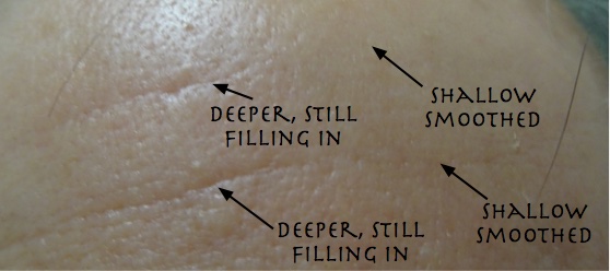 A little different camera angle, results after 3 Derminator single needle cartridge treatments on lines. Note the trace of the line as it fills in. Photo taken 6/6/18.