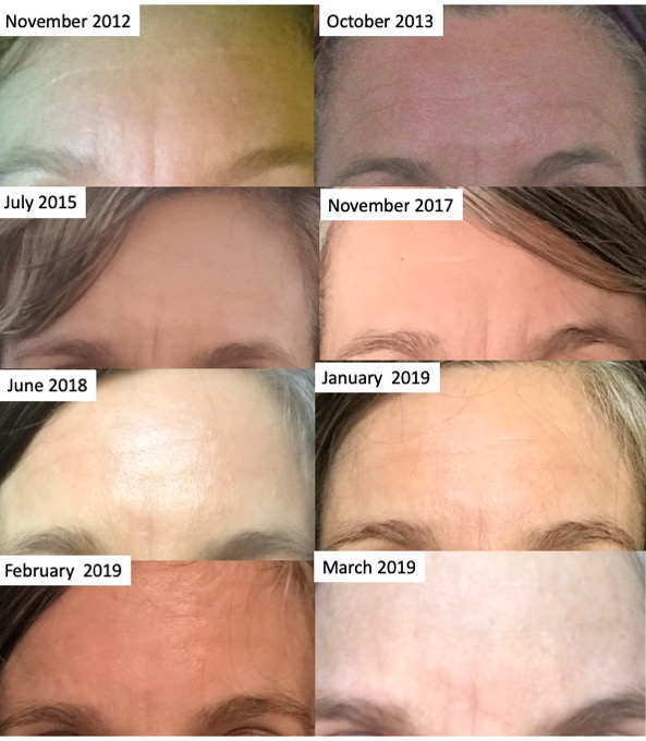 I began using forehead rejuvenation techniques in about January 2018. These photos show forehead conditions pre- and post-forehead rejuvenation practices.