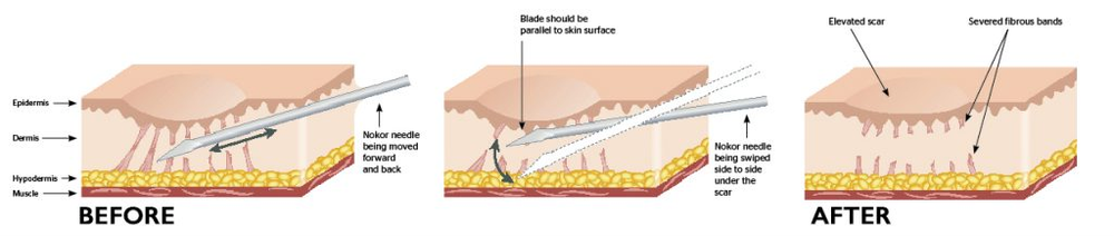 Subcision Skin Changes Subcision to Treat Scars and Wrinkles by Deborah Tosline — Skin ...