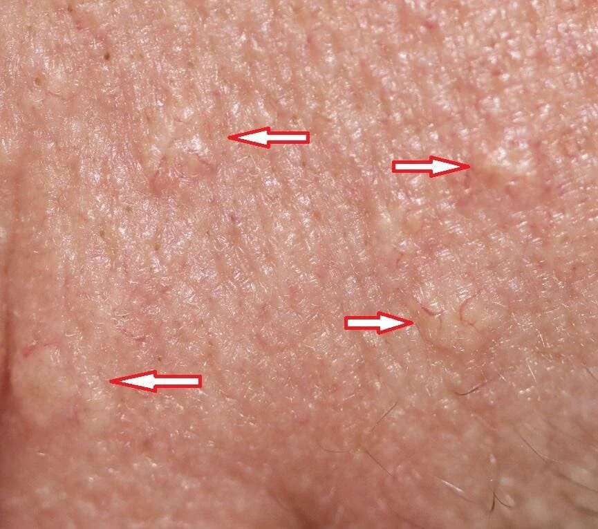 Bumpy Skin, Sebaceous Hyperplasia and Electrocautery by Deborah Tosline ...