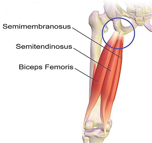Complete Proximal Hamstring Avulsion and Surgical Reattachment of ...