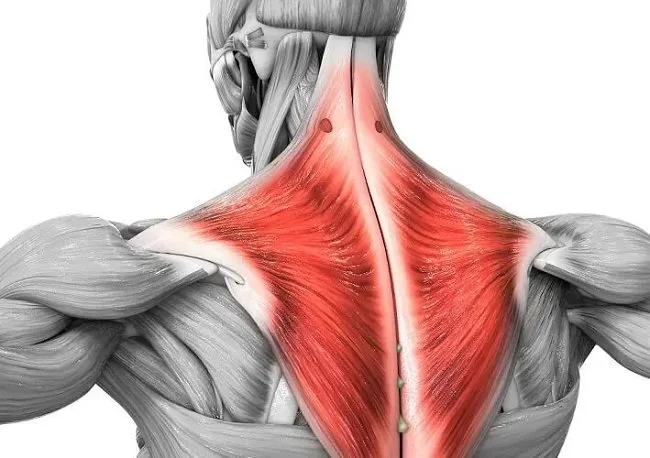 Trapezius Myalgia