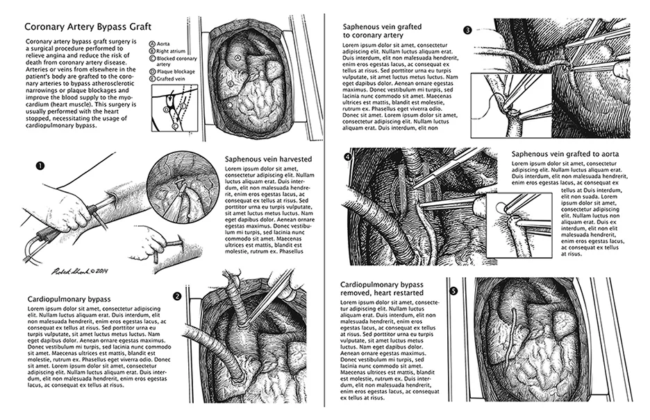 Coronary bypass sequence