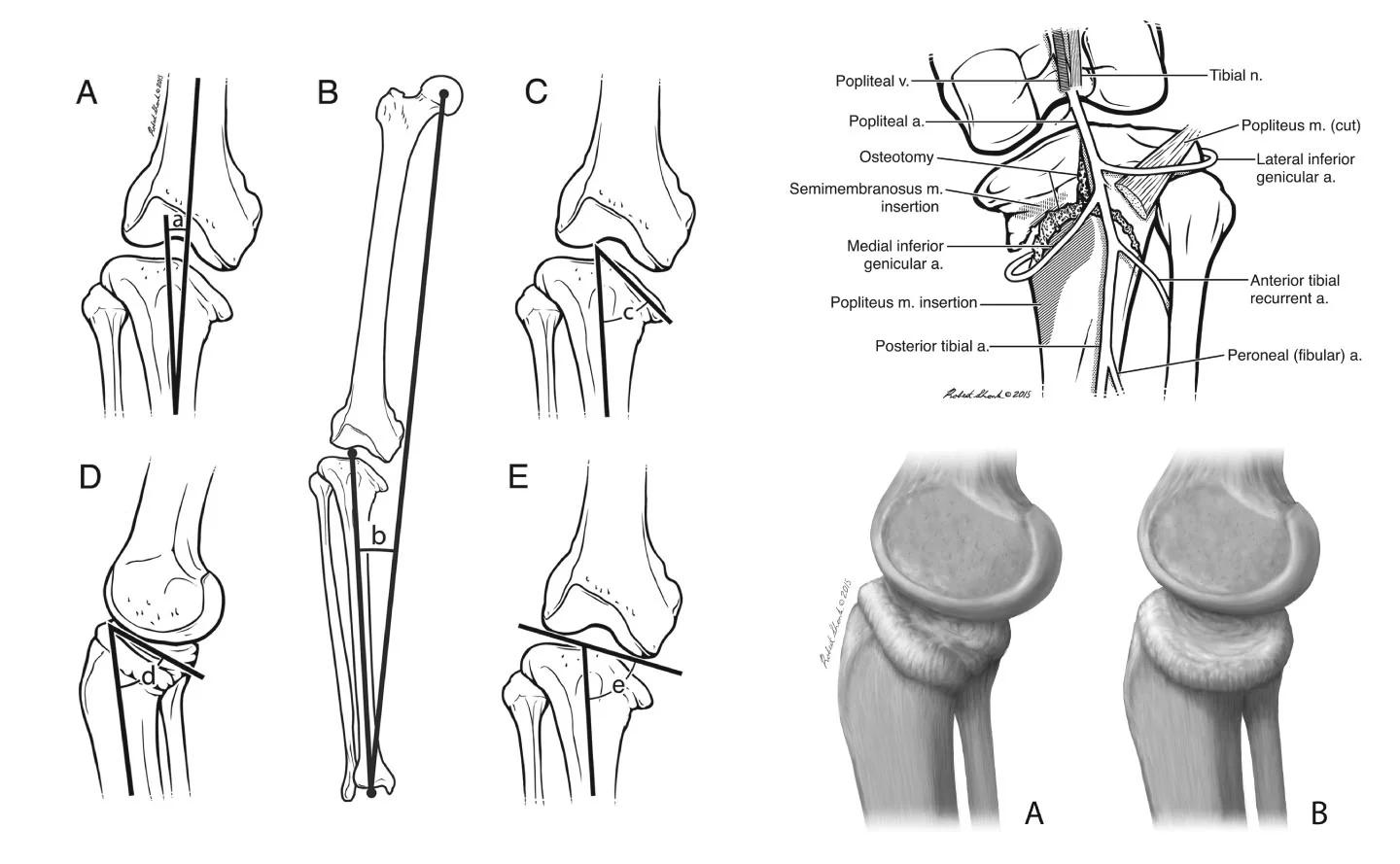Tibia Vera (Knee joint pathology)