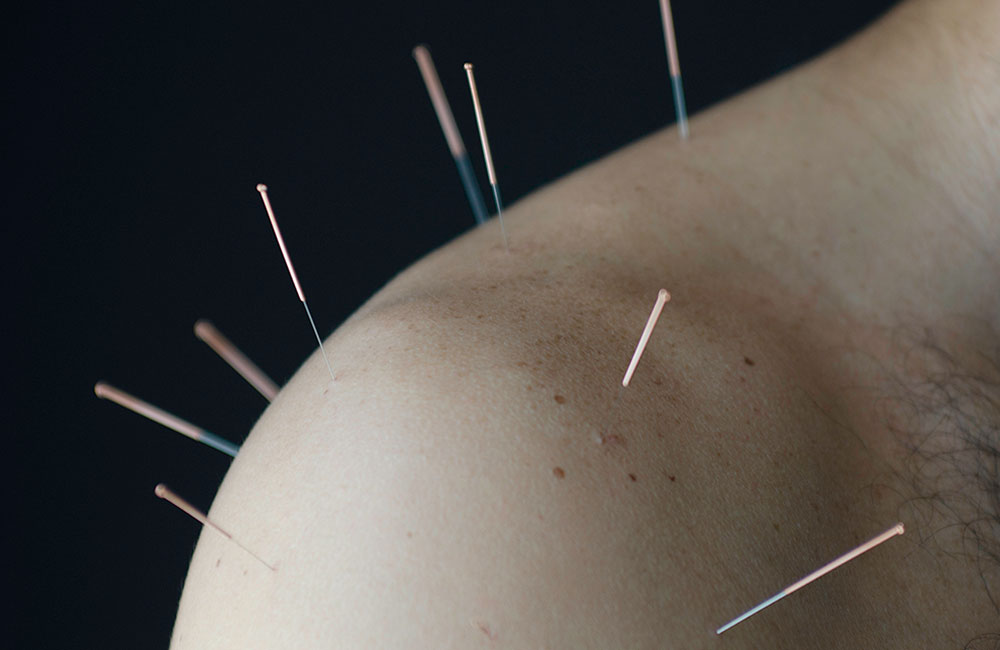 acupuncserv.jpg