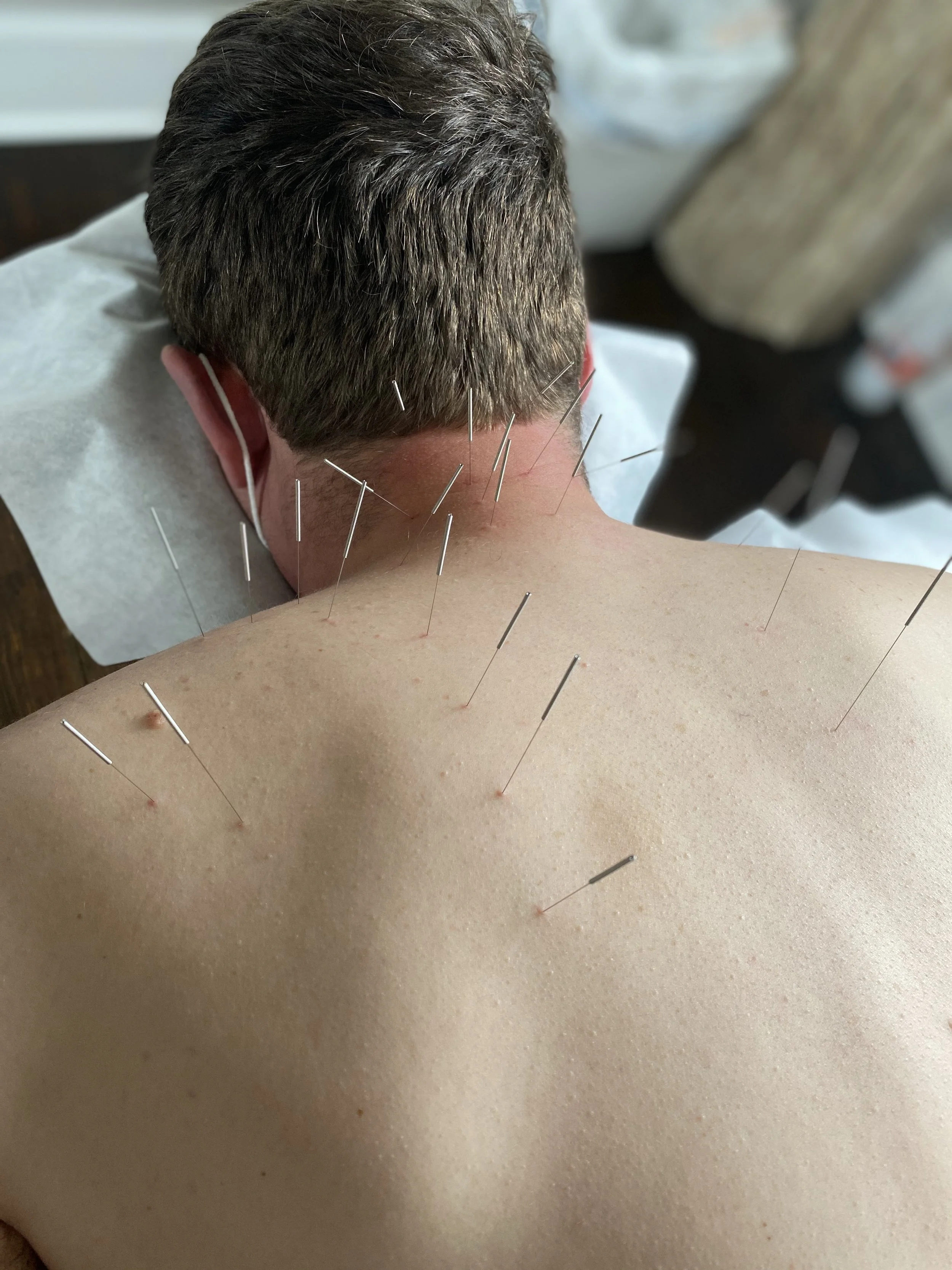 Acupuncture for Sports Injuries