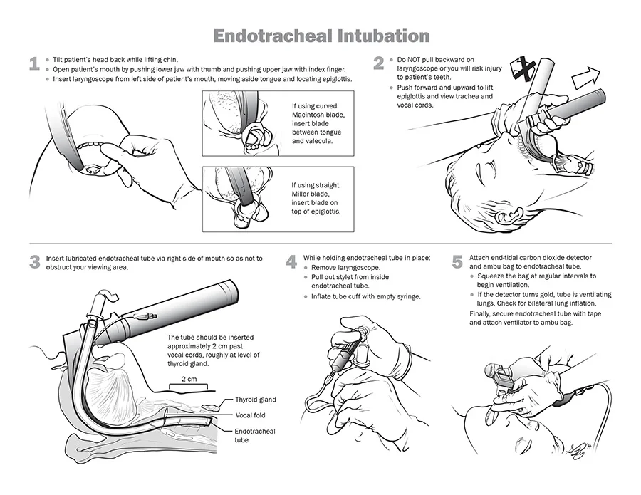 Endotracheal Intubation