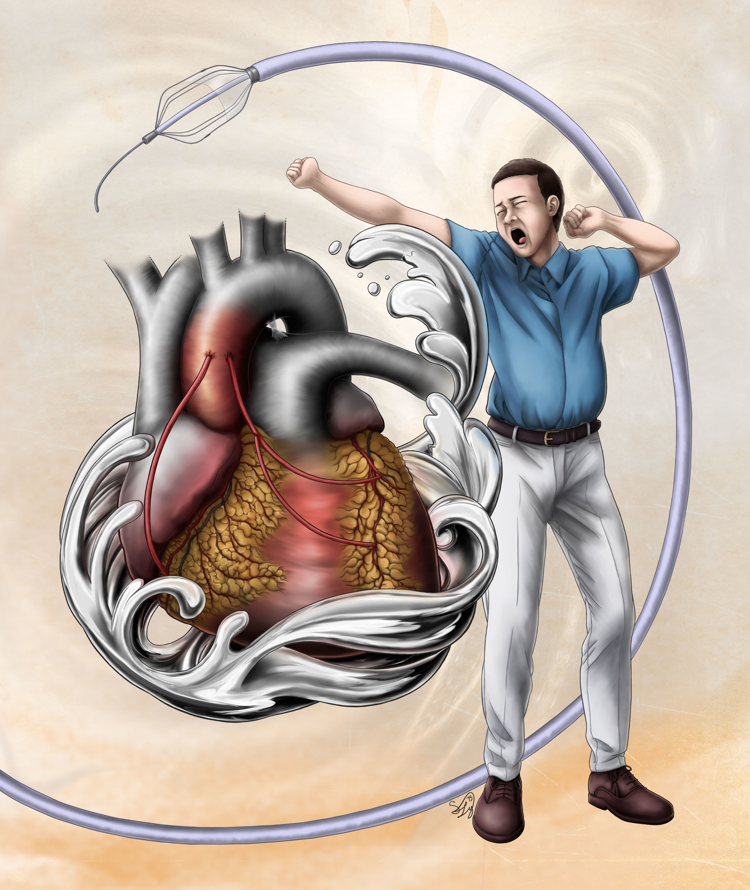 ESOPUS: Coronary Artery Disease