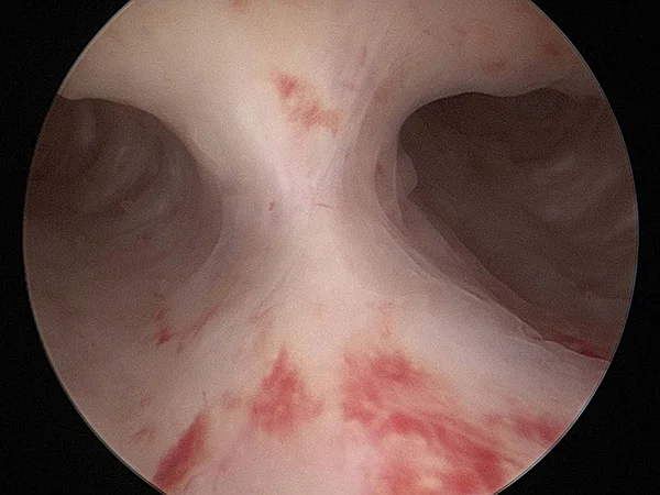 This is where there is a dividing band in the uterus and you were born this way We remove it as it can be associated with pregnancy losses around 12 - 16 weeks