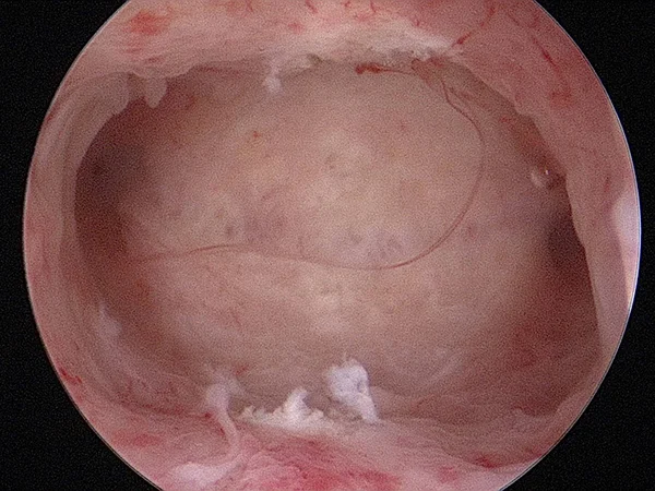 View of cavity after resecting the septum