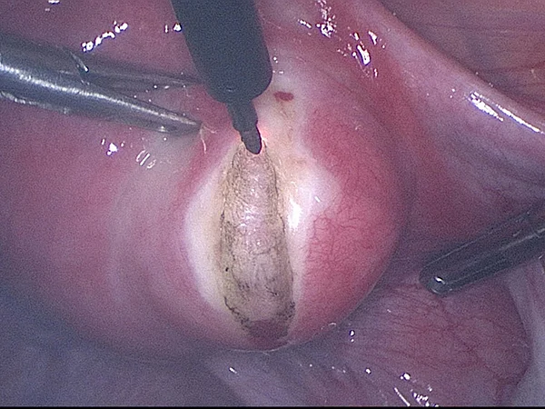 Cutting open the surface of the uterus to get to the intra-mural fibroid