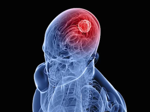 Brain Cancer & Cell Phones