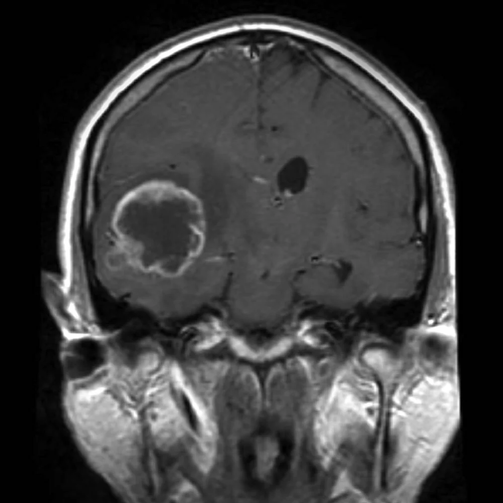 Has Cell Phone Use Increased Rate Of Brain Cancer And Glioma?