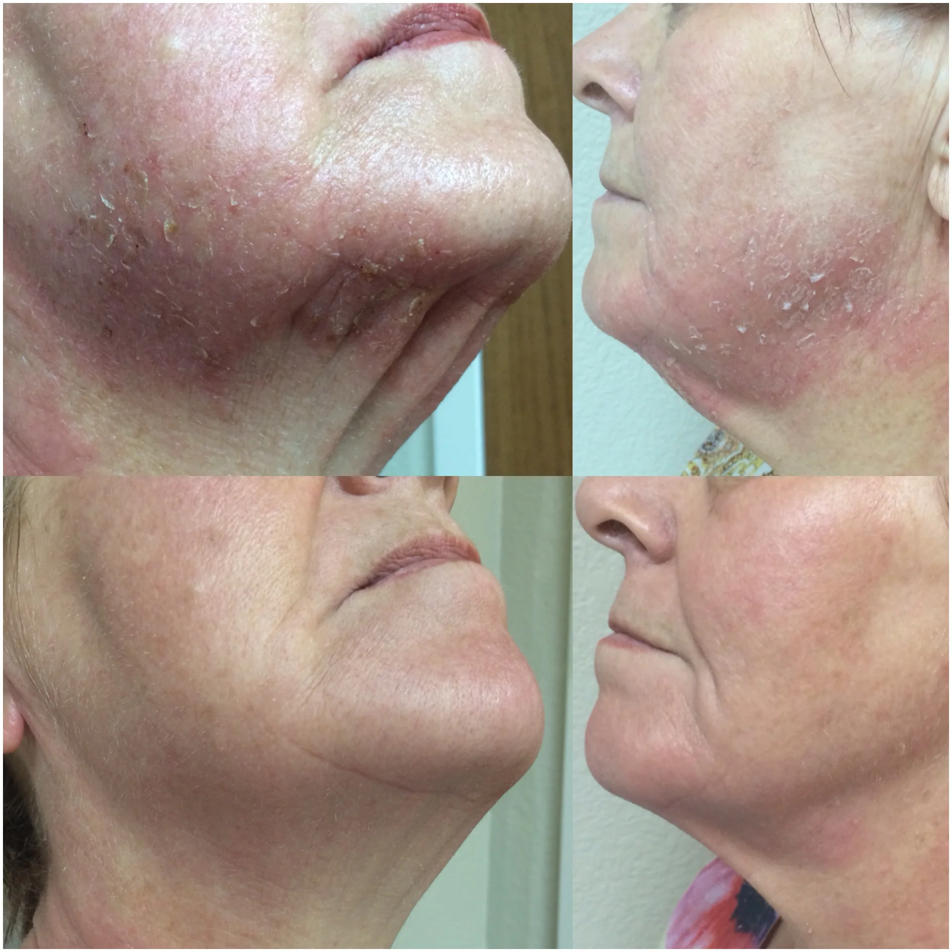 Seborrheic Dermatitis