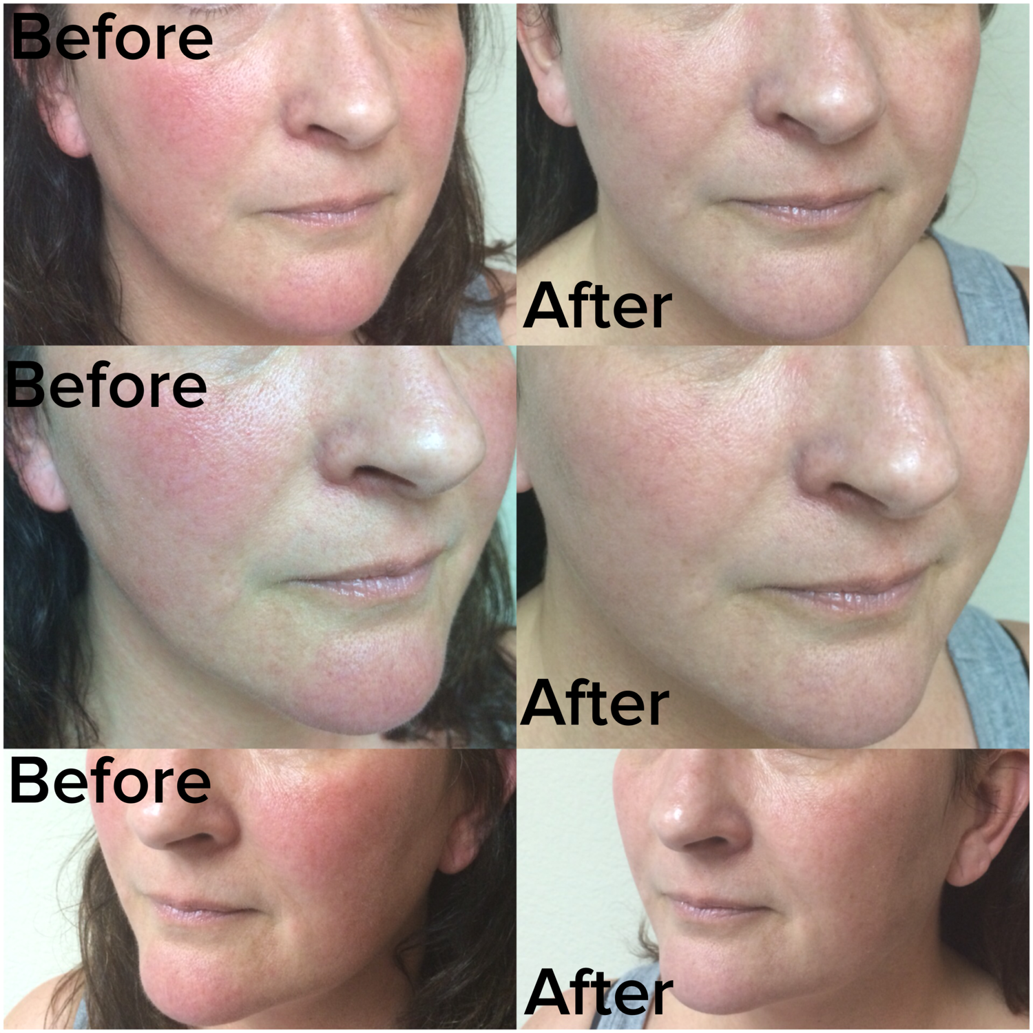 Rosacea