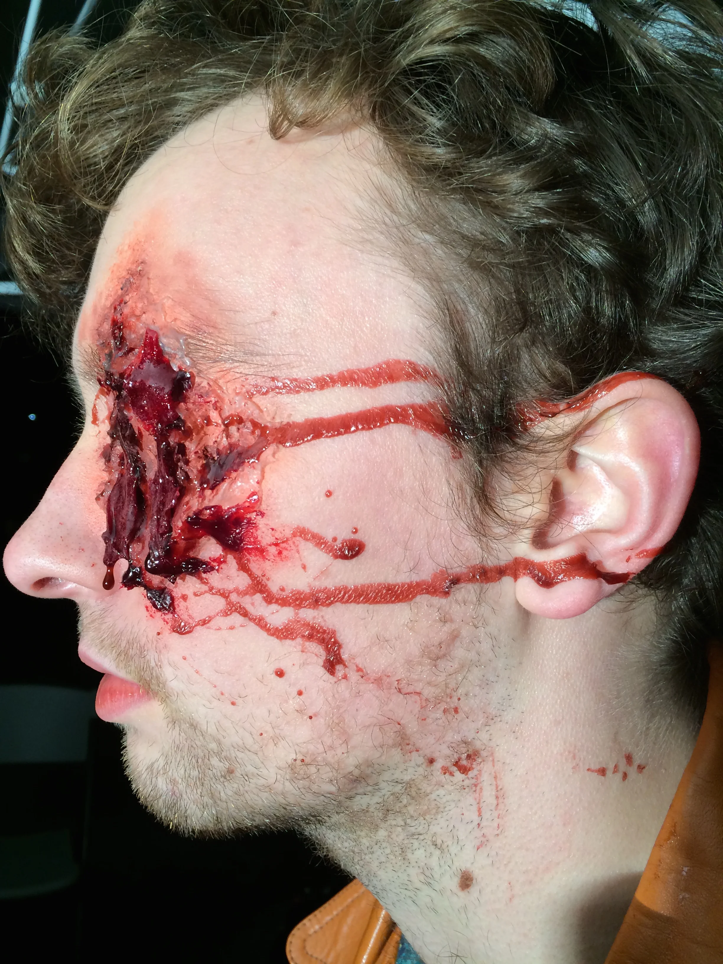 This is the actor Matthew Van Gessel with an eye prosthetic.