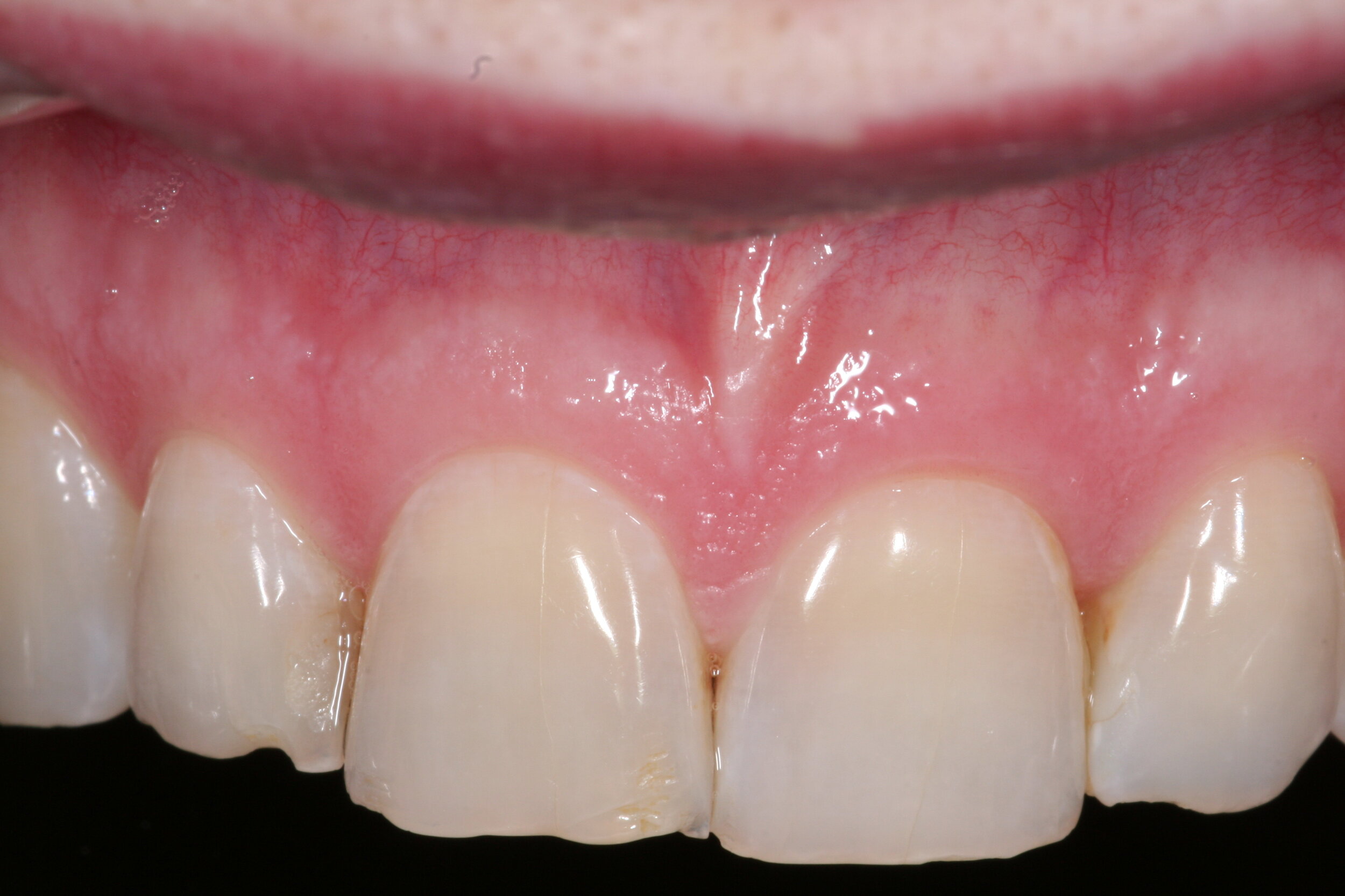 What To Do If You Crack Chip Or Break A Tooth - Radiance Dental