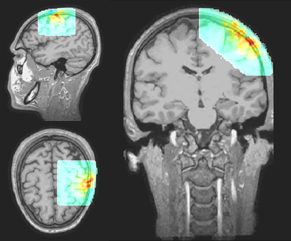 4) Tomographic brain imaging with fNIRS system by NIRx