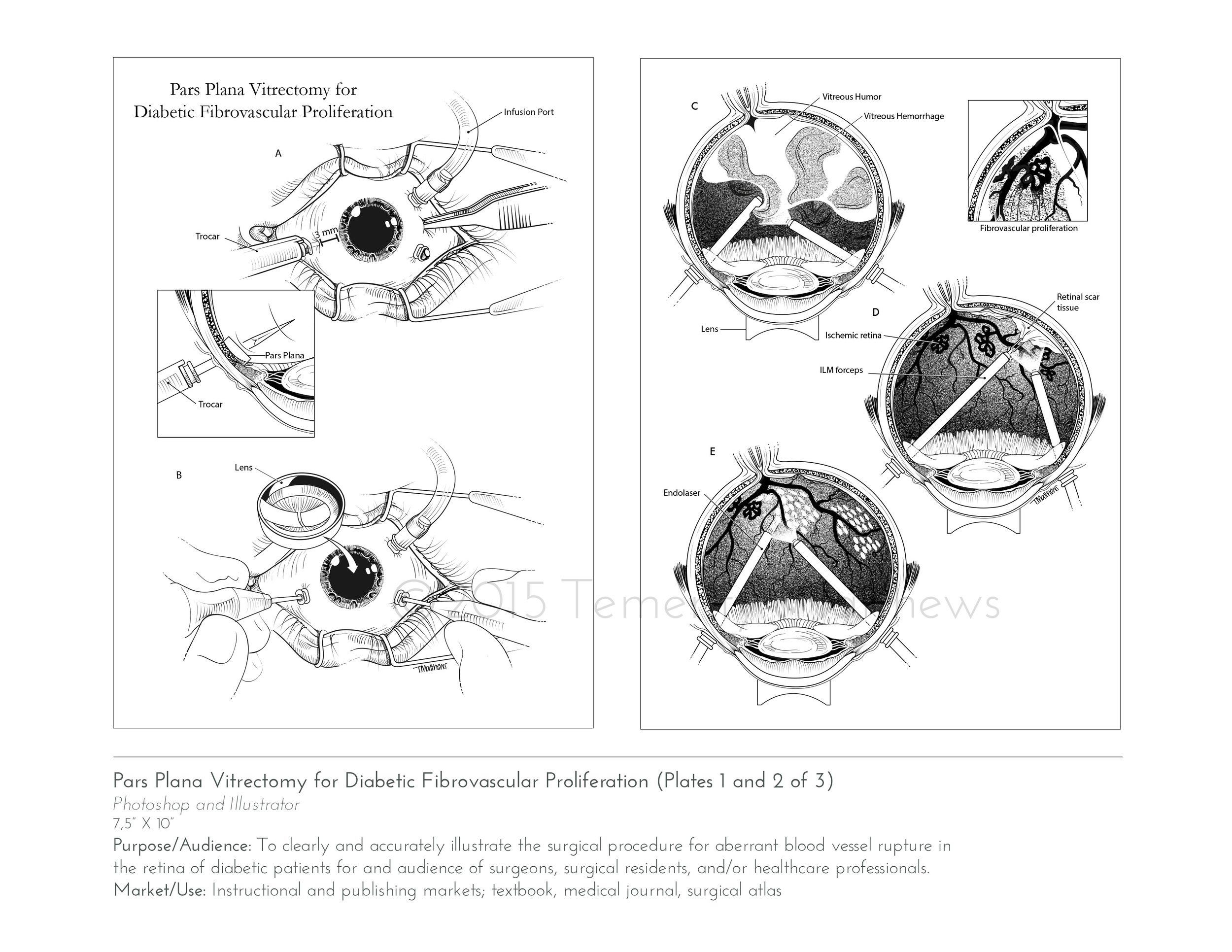 vitrectomy1.jpg