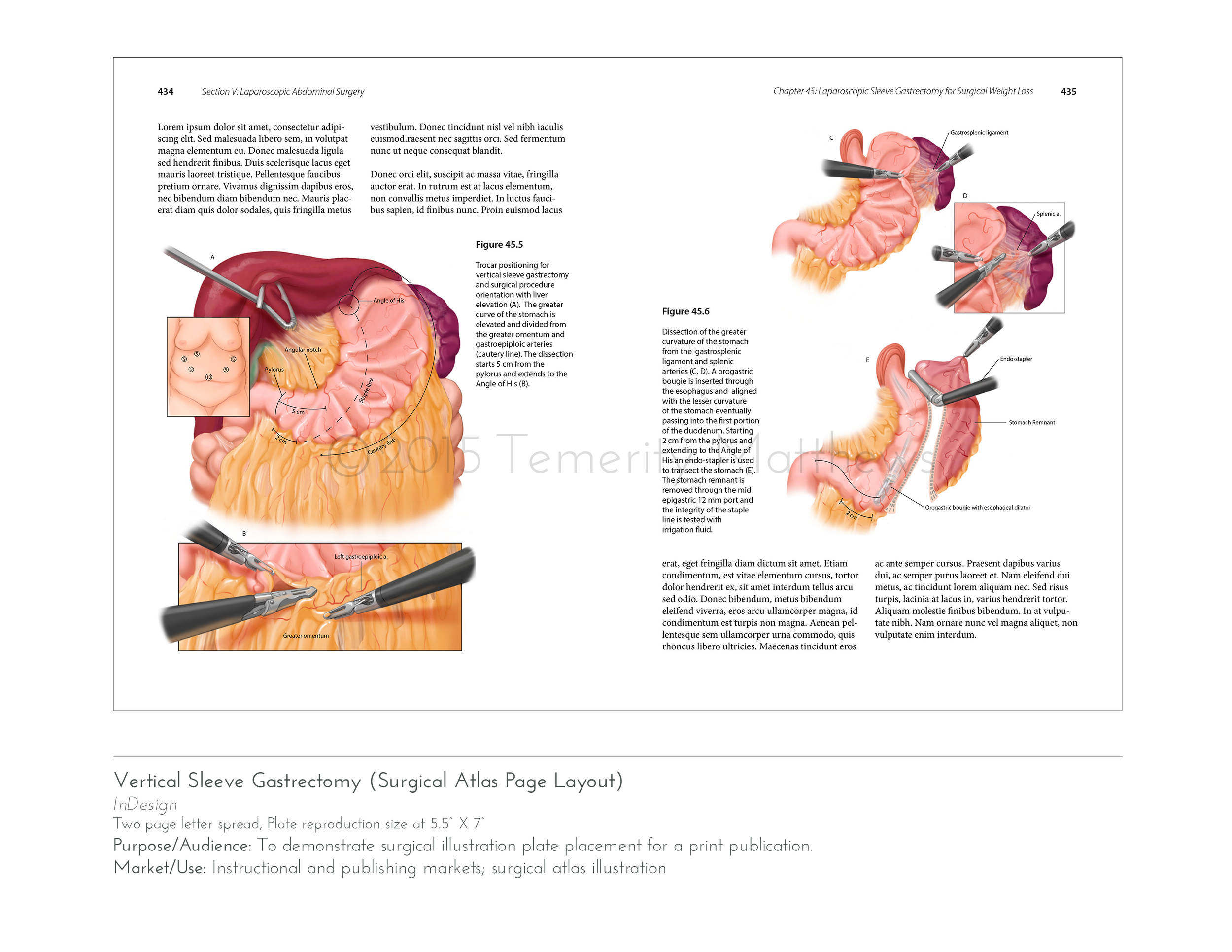 gastricsleevelayoutweb.jpg