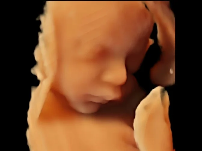 3D ultrasound