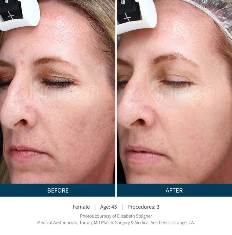 Microneedling — Bella Medical Spa